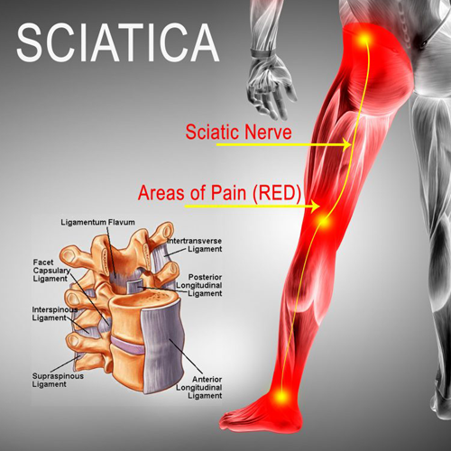 Sciatica Genesis Physical Medicine and Chiropractic Fort Lauderdale FL